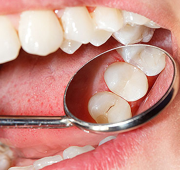 Otturazioni-dentali-brescia-mobile